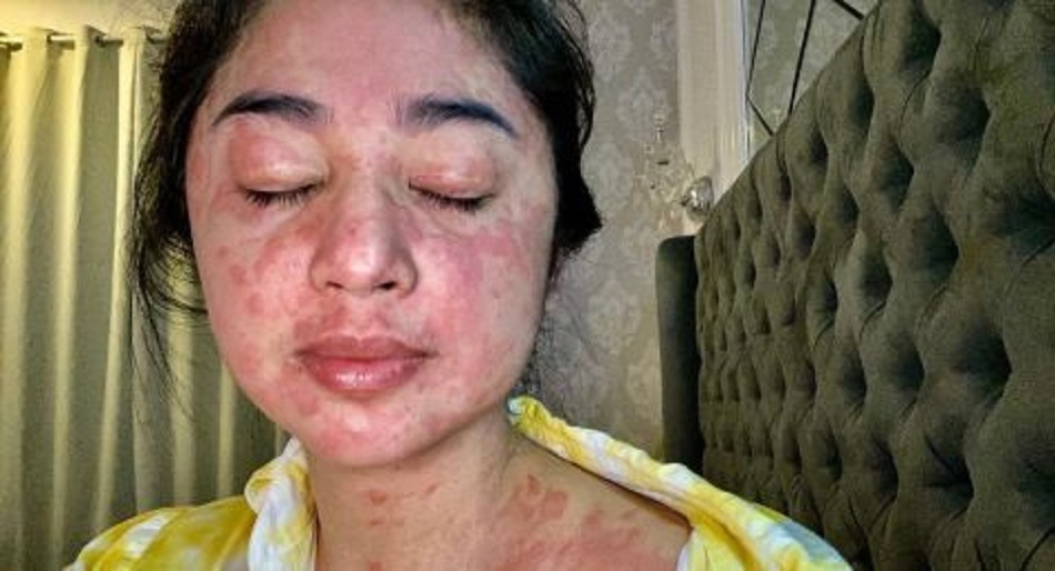 Wajah dan tubuh Dewi Perssik merah usai dinyatakan terinfeksi Covid-19 (Foto: Instagram/Dewi Persik)
